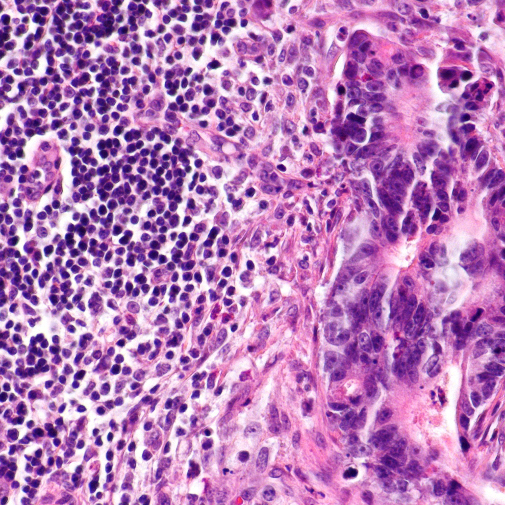 H&E of a lymph node with a metastatic tumor focus